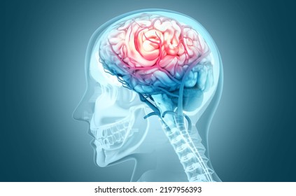 Human brain injury,damage,hemorrhage. 3d illustration - Powered by Shutterstock