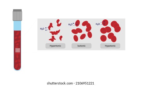 Human Cell Osmosis. Hemoglobin In A Isotonic, Hypertonic And Hypotonic Illustration 