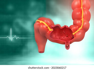 Human Colon Cancer. 3d Illustration	