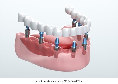 Human Dental Implant Isolated Gray 3d Stock Illustration 2153964287 ...