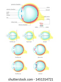 Human Eye Anatomy Cross Section Medical Diagram, Flat Isolated Illustration. Structure Of Healthy Eye And With Glaucoma, Cataract, Hyperopia, Myopia Diseases And Disorders.