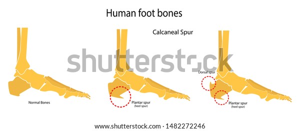 dorsal calcaneal spur