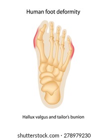 Human Foot Deformity. Hallux Valgus And Tailors Bunion.