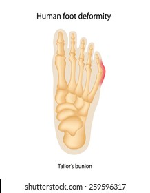 Human Foot Deformity. Tailors Bunion.