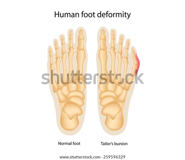 Human Foot Deformity Tailors Bunion Stock Illustration 259596329 ...