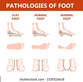 2,668 Lateral foot Images, Stock Photos & Vectors | Shutterstock