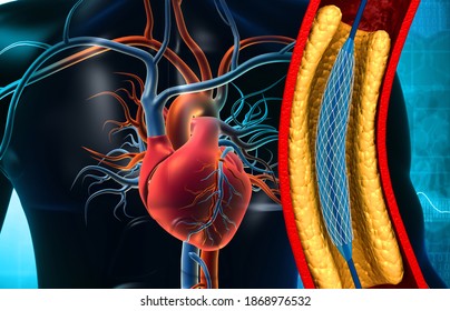 Human heart with Balloon angioplasty.3d illustration	