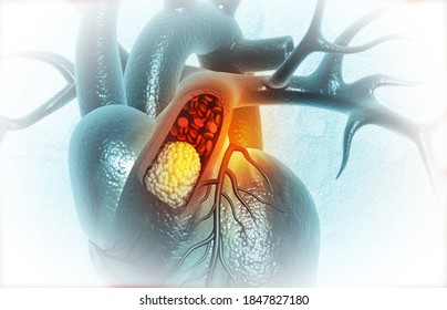 Human Heart With Clogged Arteries. 3d Illustration		