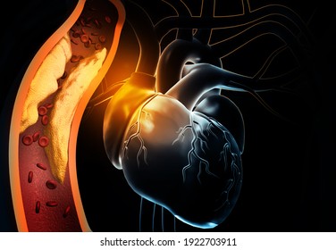 Human heart with clogged arteries. 3d illustration	