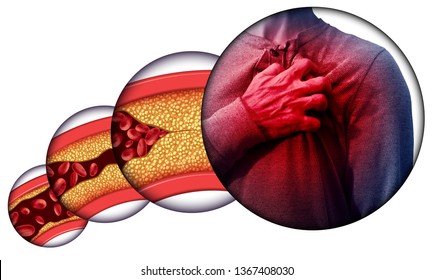 Human heart disease and chest pain from clogged arteries and artery damaged with cholesterol resulting in a cardiac arrest with 3D illustration elements.