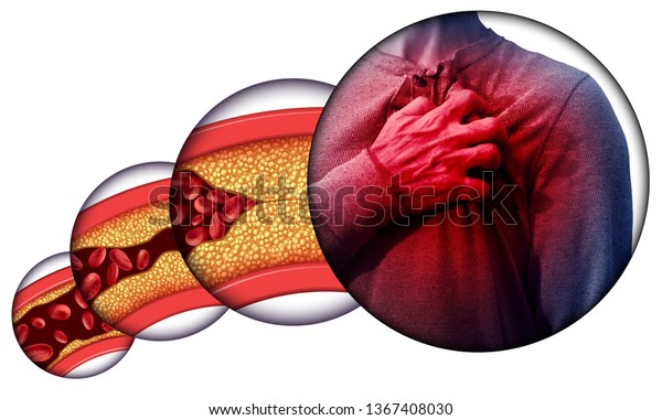 コレステロールで損傷した動脈や動脈の詰まった動脈からのヒトの心臓疾患や胸痛は 3dイラストエレメントによって心停止を引き起こします のイラスト素材