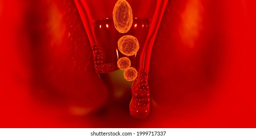 Human Hemorrhoids , Piles, Fistula, Fissure. 3d Illustration