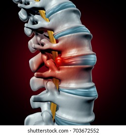 Human herniated disk concept and spine pain diagnostic as a human spinal system problem and anatomy symbol with the skeletal bone structure and discs as a 3D illustration.