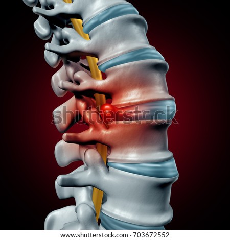 Human herniated disk concept and spine pain diagnostic as a human spinal system problem and anatomy symbol with the skeletal bone structure and discs as a 3D illustration. Stock photo © 