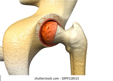 Human Hip Joint. Arthritis Of The Hip Joint. 3d Illustration