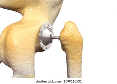 Human Hip Joint Surgery. Arthritis Of The Hip Joint. 3d Illustration