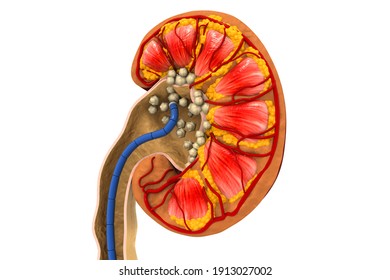 Human Kidney stones medical concept. Cross section. 3d illustration