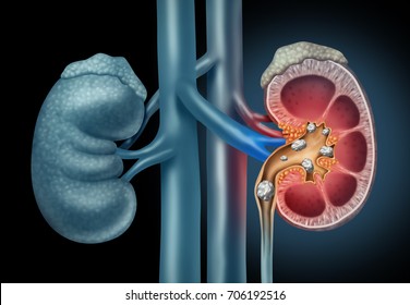Human Kidney stones medical concept as an organ with painful mineral formations as a medicine symbol with a cross section with 3D illustration elements.