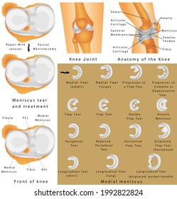 Human Knee Joint. Anatomy Of The Knee. Menisci Of The Knee. Medial Meniscus. Lateral Meniscus. Meniscus Tear And Surgery