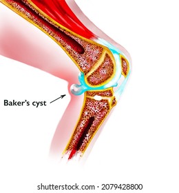 Human Knee Joint Baker's Cyst.