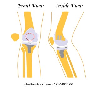 Human Knee Leg Front Back View Stock Illustration 1934491499 | Shutterstock