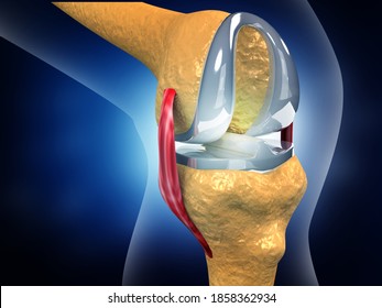 Human Knee Replacement Implant. 3d Illustration	