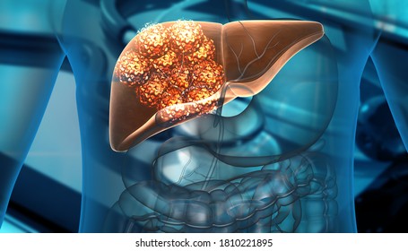 Human Liver Cancer Cell Growth. 3d Illustration	