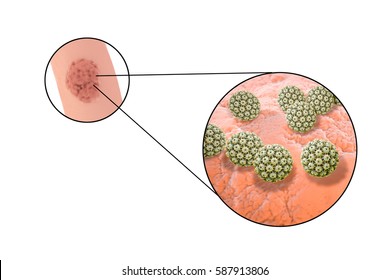 A középgarat tumorok 40 százalékát a HPV okozza