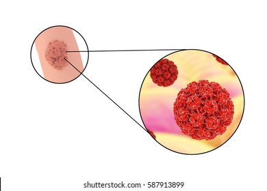 Human Papillomavirus HPV Lesions In Men, Genital Warts, And Close-up View Of HPV. 3D Illustration