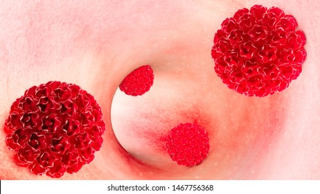 Human papillomavirus infection. Virus. HPV is the most common sexually transmitted infection globally. HPV infection is caused by human papillomavirus, a DNA virus, 3d rendering