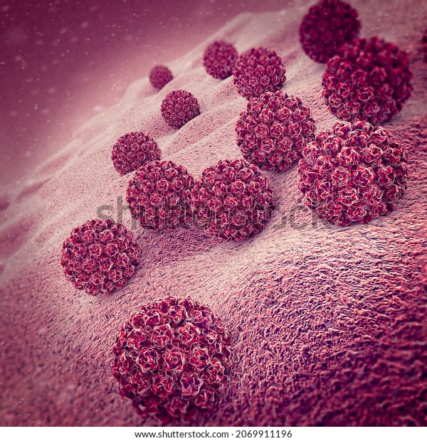 Human\
papillomavirus infection. Virus. HPV is the most common sexually\
transmitted infection globally. HPV infection is caused by human\
papillomavirus, a DNA virus 3d\
rendering