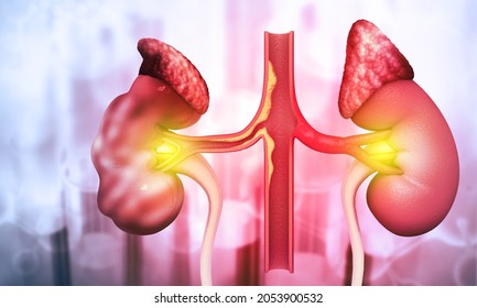 Human Polycystic Kidney Disease. 3d Illustration