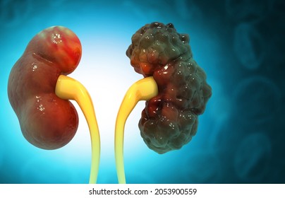 Human Polycystic Kidney Disease. 3d Illustration