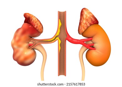 Human Polycystic Kidney Disease. 3d Illustration