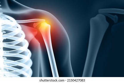 Human Shoulder Joint Pain Xray View Stock Illustration 2150427083 ...