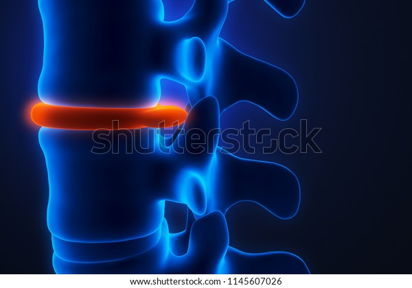 Human Spinal System Problem Concept Thinning Stock Illustration ...