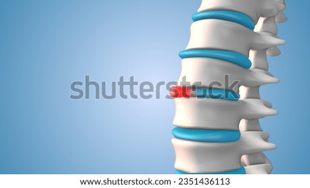 Human spine bulging or herniated disc 3D illustration Stock photo © 