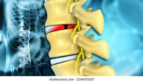 Human Spine Disc Bulge. 3d Illustration		