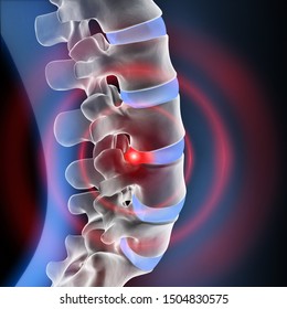 Human Spine Disc Degeneration - Spine Problems - 3D illustration