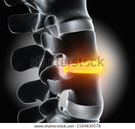 Human Spine Disc Degeneration - Spine Problems - 3D illustration Stock photo © 