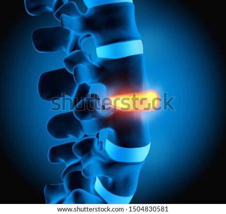 Human Spine Disc Degeneration - Spine Problems - 3D illustration Stock photo © 