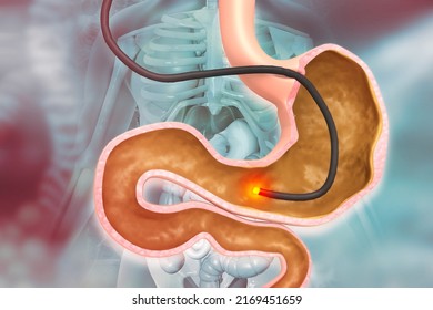 Human Stomach With Endoscope And Close-up View Of Bacterium Helicobacter Pylori Which Causes Ulcers, Stomach Ulcer Or Gastric Ulcer, 3d Illustration