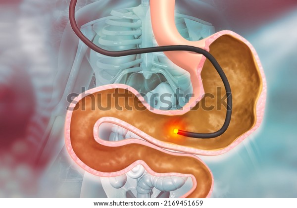 Human Stomach with endoscope and close-up\
view of bacterium Helicobacter pylori which causes ulcers, stomach\
ulcer or gastric ulcer, 3d\
illustration