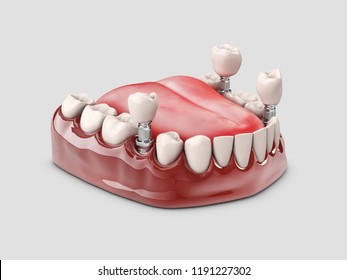 Human Teeth And Dental Implant. 3d Illustration