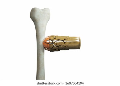 Human Thigh Bone Hitting From A Bullet And Destroy It In White Background. Strong Bones And Healthy Human Bone Or Osteoporosis World Day Or Retirement Age Or Strong Bones Concept. 3D Illustration