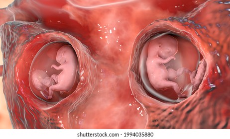 Human twins inside female uterus with two chorions and two amnions, 3D illustration. Human embryo, week 8