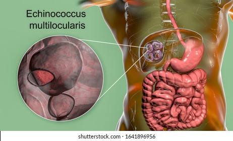 Hydatid cyst of Echinococcus multilocularis, closeup view, 3D illustration. E. multilocularis is a parasitic worm that causes alveolar echinococcosis with production of cysts in liver