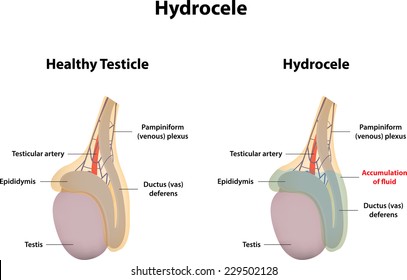 Hydrocele