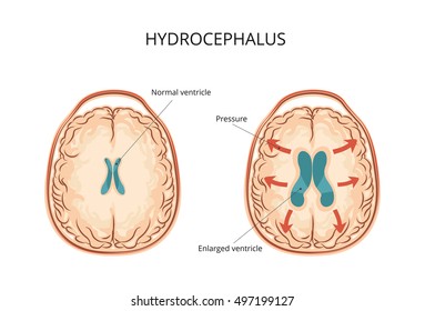 Hydrocephalus