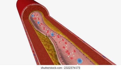 Hypercholesterolemia is a condition characterized by higher than average levels of cholesterol in the bloodstream. 3D Render